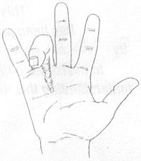 Dupuytren’s disease diagram