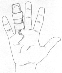 Dupuytren’s disease diagram