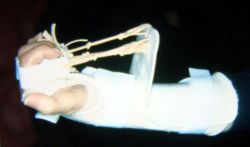 Complex Splint